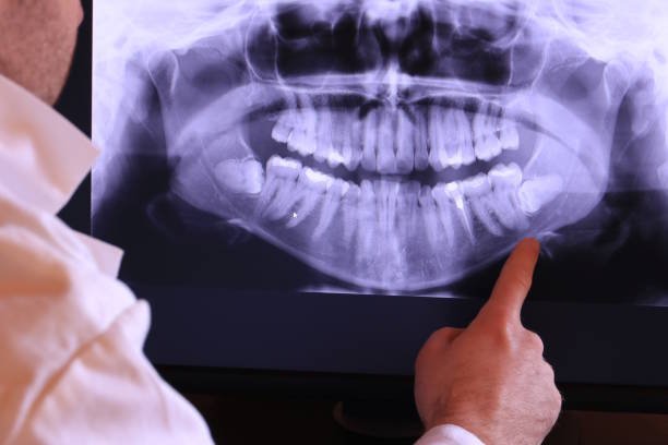 Best Emergency Wisdom Tooth Extraction in Decatur, IL