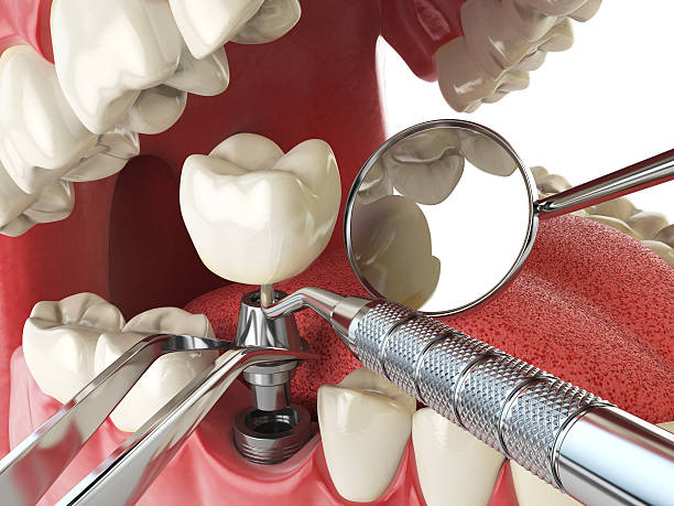 Best Emergency Denture Repair in Decatur, IL